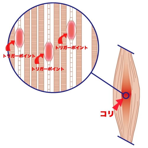 トリガーポイント詳細